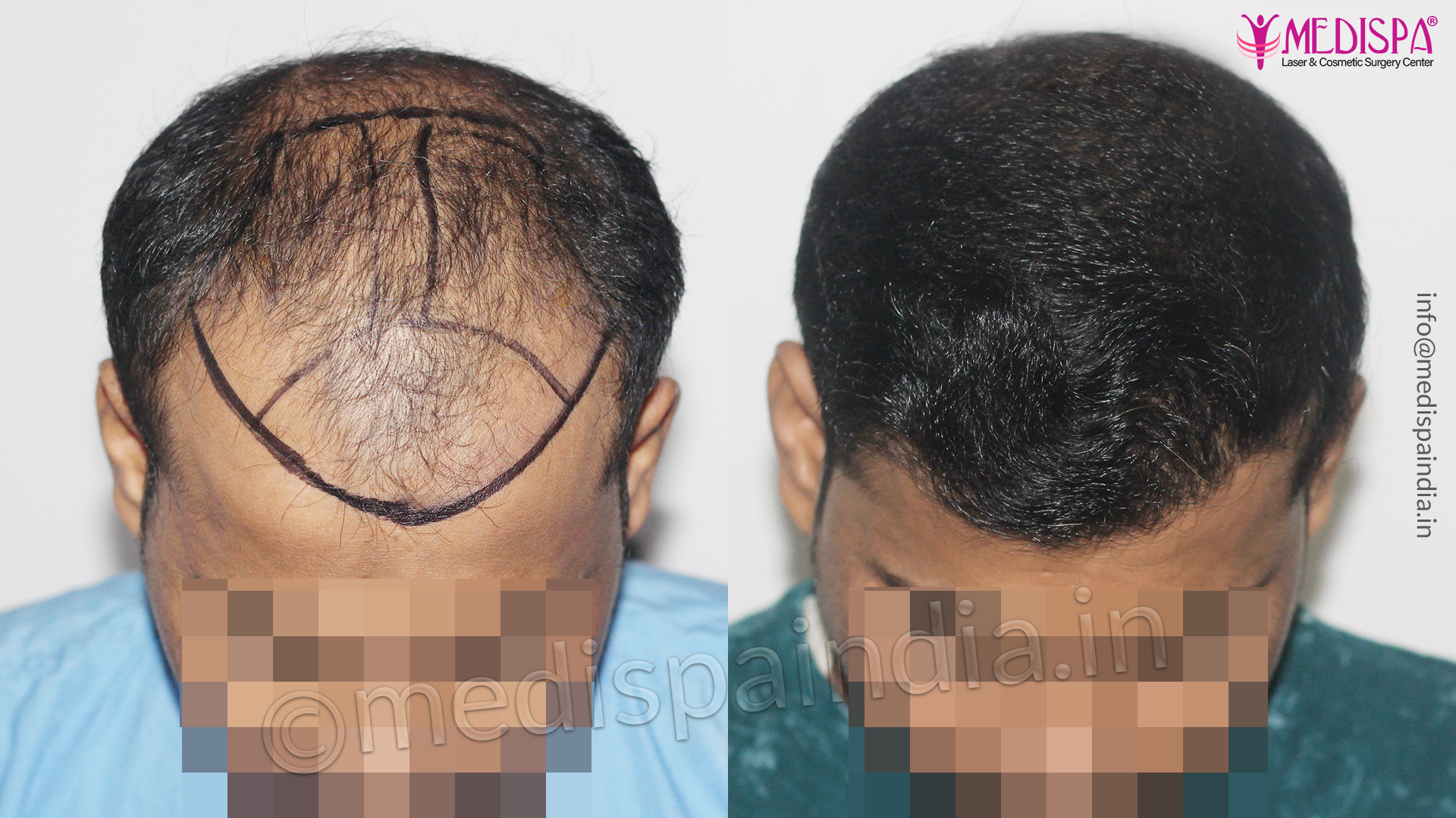 Medispa Hair Transplant Center, Jaipur | Address Guru