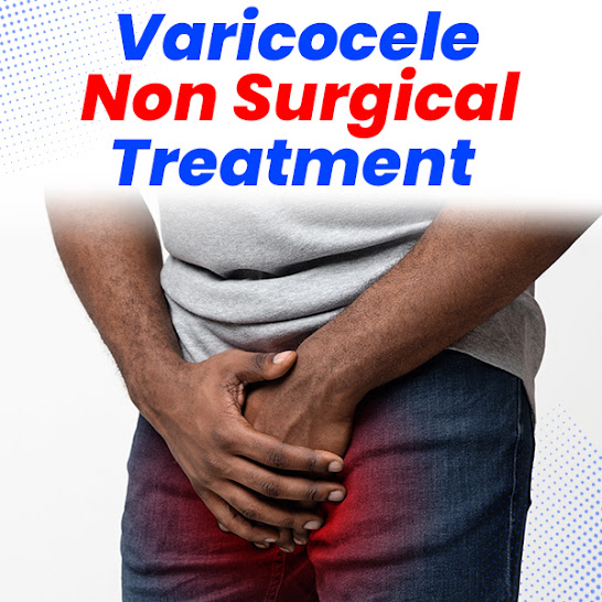 varicocele treatment without surgery
