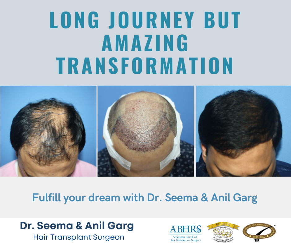 Rejuvenate Hair Transplant