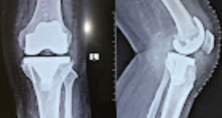 Dr. Kumar Anupam, Best Orthopedic Surgeon in Gaya