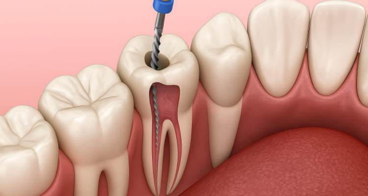 Root Canal Treatment in Madurai